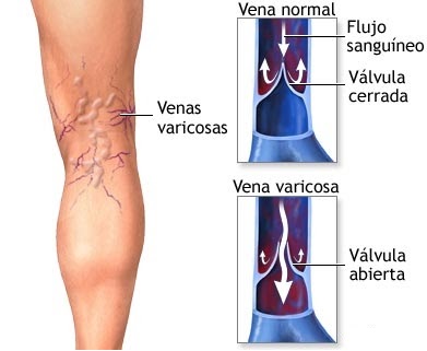 Espuma escleroterapia varices